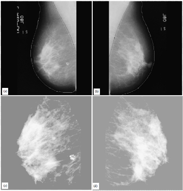 Image for - A Review of Computer-Aided Detection and Diagnosis of Breast Cancer in Digital Mammography