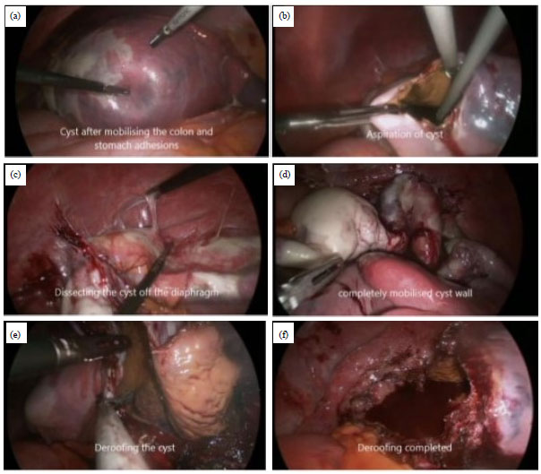 Image for - Laparoscopic Partial Cystectomy for Non-Parasitic Splenic Cyst: A Case and Literature Review