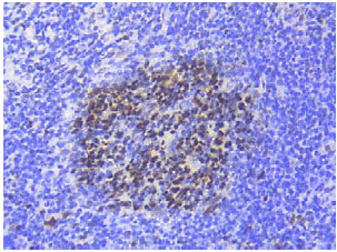Image for - Expression of MSH2 in Head and Neck Lymphomas (A Study Utilizing Immunohistochemistry and Real-time Polymerase Chain Reaction)