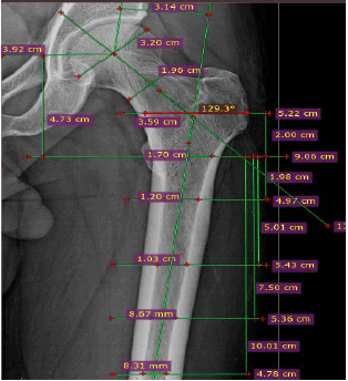 Image for - Standardized Hip Implant by Cluster Analysis of AnthropometryParameters of Femur