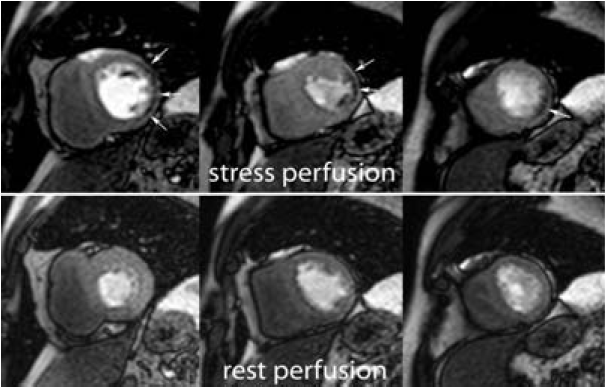 Image for - Cardiac Magnetic Resonance Imaging in the Diagnosis of Ischemic Heart Disease