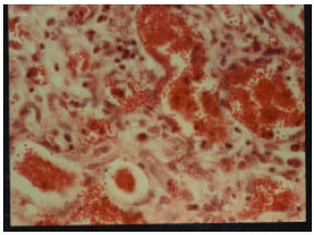 Image for - Contagious Ecthyma: Case Report and Review