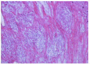 Image for - Pleural Mesothelioma in a Sheep