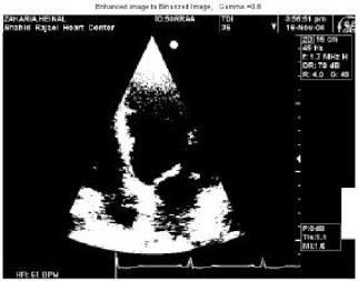 Image for - Determination of Instantaneous Interventricular Septum Wall Thickness by Processing Sequential 2D Echocardiographic Images