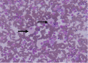 Image for - Gaucher Disease: A 10 Year Old Girl with Anemia and Huge Spelenomegaly (A Case Report)