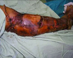 Image for - Full-Thickness Skin Avulsion of Right Leg Following Car Accident Trauma