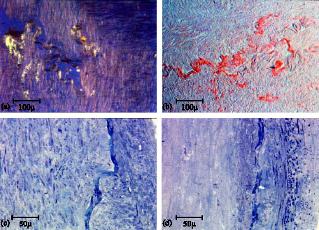 Image for - Amyloid Deposits in Senile Vertebral Arteries, Immunohistological and Ultrastructural Findings