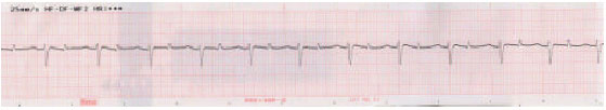 Image for - The Relationship Between KCl Infusion and Changes  of ECG, Electrolytes of Plasma and K Content of Donkey