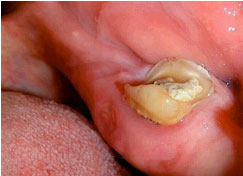 Image for - Ulcerative Gingival Granuloma: A Condition for Bone Biopsy