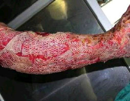 Image for - Full-Thickness Skin Avulsion of Right Leg Following Car Accident Trauma