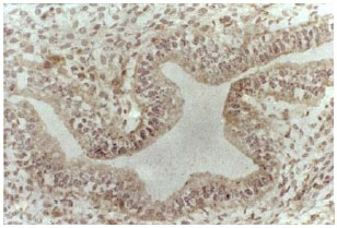 Image for - Beta3 Integrin Expression within Uterine Endometrium and its Relationship  with Unexplained Infertility