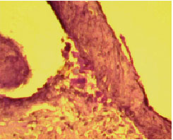Image for - Ulcerative Gingival Granuloma: A Condition for Bone Biopsy