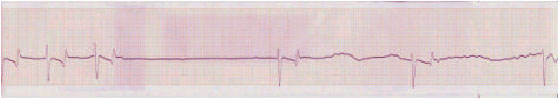 Image for - The Relationship Between KCl Infusion and Changes  of ECG, Electrolytes of Plasma and K Content of Donkey