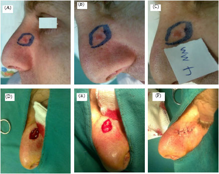 Image for - Safety Margin in Excision of Basal Cell Carcinoma