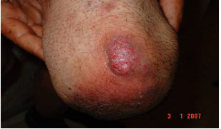 Image for - Skin Disorders Associated with Bilateral Lower Extremity Amputation