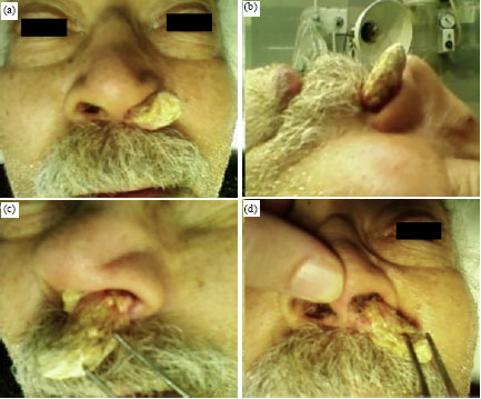 Image for - Nasal Vestibular Huge Keratoacanthoma: An Unusual Site