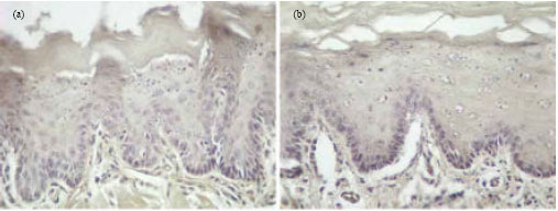 Image for - Effect of Dietary and Topical Celecoxib on Expression of bcl-2, bax, c-erb-B2 and Ki67 in Carcinogen-Induced Tongue Carcinoma in Rat