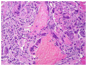 Image for - Evaluation of Characteristics of Patients with Pilomatricoma in Mazandaran Province, 1996-2006