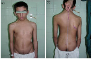 Image for - Scoliosis Curve: Before and After Surgical Correction