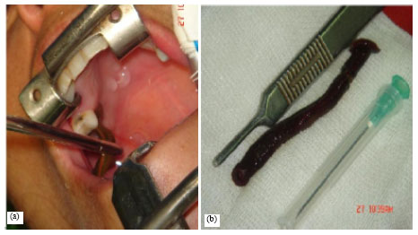 Image for - Meta Analysis of the Leech as a Live Foreign Body: Detection, Precaution and Treatment