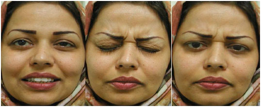 Image for - Transient Facial Nerve Baroparesis: Case Report