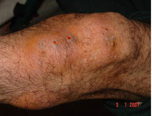 Image for - Skin Disorders Associated with Bilateral Lower Extremity Amputation