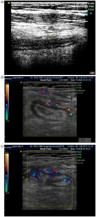 Image for - Accuracy of Sonography in Diagnosis of Acute Appendicitis Running