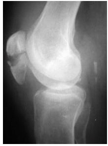 Image for - A Study of the Long Term Effects of Anatomical Open Reduction of Patella on Patellofemoral Articular Cartilage in follow up Arthroscopy
