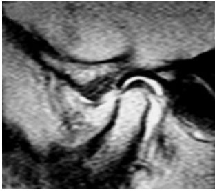 Image for - Serum S100A12 and Temporomandibular Joint Magnetic Resonance Imaging in Juvenile Idiopathic Arthritis Egyptian Patients: A case Control Study