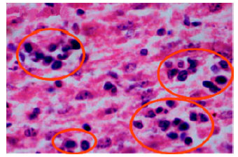 Image for - Rapid Metastasis of Breast Cancer Cells from Primary Tumour to Liver