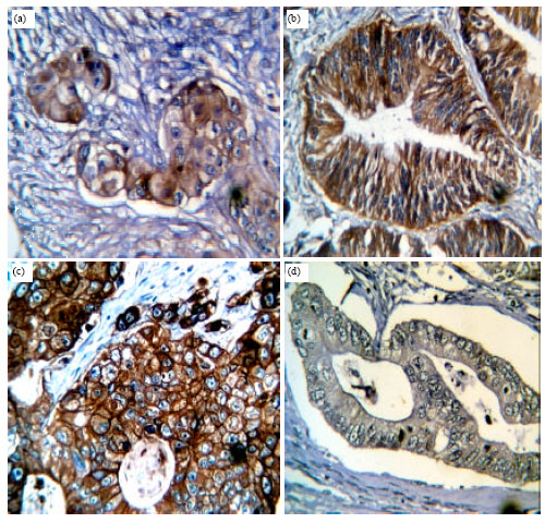 Image for - Expression of Membranous Epidermal Growth Factor Receptor in Colorectal  Adenocarcinoma and It ’ s Correlation with Clinicopathological Features