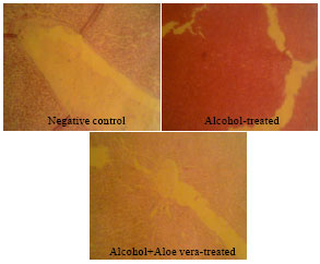 Image for - Hepatotherapeutic Effect of Aloe Vera in Alcohol-induced Hepatic Damage