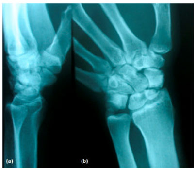 Image for - Using a Vascularized Bone Graft from the Distal Metaphysis of Radius in Treating Scaphoid Nonunion: First Report from a Developing Country