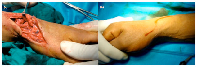 Image for - Using a Vascularized Bone Graft from the Distal Metaphysis of Radius in Treating Scaphoid Nonunion: First Report from a Developing Country