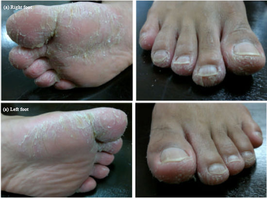 Multiple Rare Opportunistic and Pathogenic Fungi in Persistent Foot Skin  Infection
