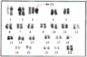 Image for - Detection P53 Gene Deletion in Hematological Malignancies Using Fluorescence In situ Hybridization: A Pilot Study