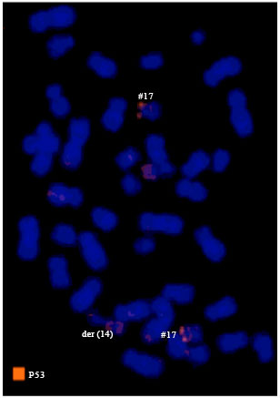 Image for - Detection P53 Gene Deletion in Hematological Malignancies Using Fluorescence In situ Hybridization: A Pilot Study
