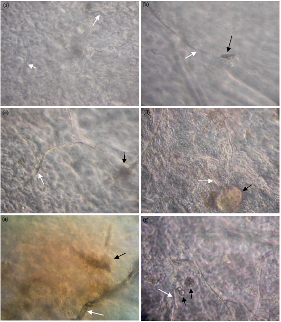 Image for - Biological Activity Alterations of Human Amniotic Membrane Preand Post Irradiation Tissue Banking