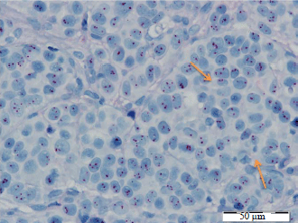 Image for - Concordance Between Immunohistochemistry (IHC) and Silver Situ Hybridization (SISH) in Endometrial Carcinoma Diagnosis: Using HER-2/neu