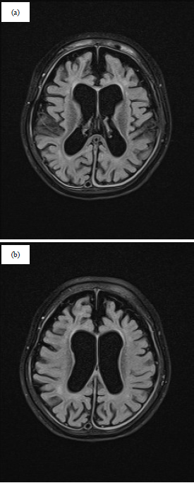 Image for - A Novel Nonsense Gene Variant Responsible for Early Infantile Epileptic Encephalopathy Type 39: Case Report