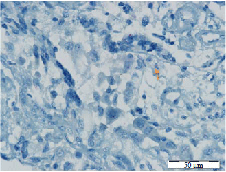 Image for - Concordance Between Immunohistochemistry (IHC) and Silver Situ Hybridization (SISH) in Endometrial Carcinoma Diagnosis: Using HER-2/neu