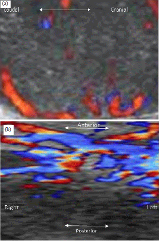 Image for - Characterization of Foot Mycetoma Using Sonography and Color Doppler Imaging