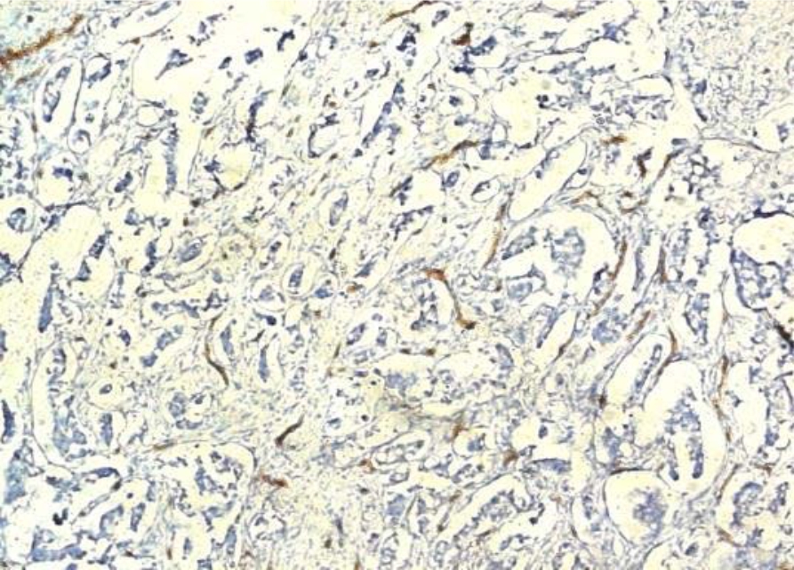 Image for - Evaluation of Angiogenesis by Using CD105 and CD34 in Sudanese Breast Cancer Patients