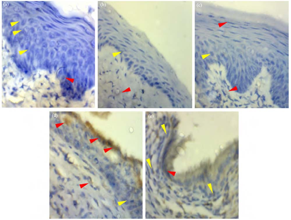 Image for - Cytochrome c Expression by Andaliman (Zanthoxylum acanthopodium) on Cervical Cancer Histology