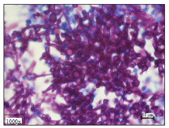 Image for - Immunosuppressive Effect of Disseminated Breast Carcinoma on Severity of Hepatic Candidiasis