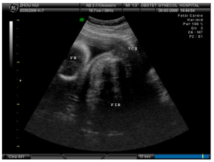Image for - Termination of Pregnancy in the Second Trimester by Hysterotomy in View of Huge Cervical Fibroid