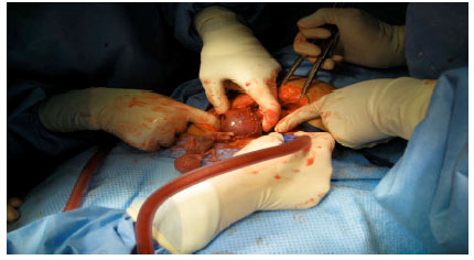 Image for - Pregnancy in Rudimentary Horn of Uterus: A Case Report