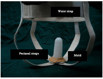Image for - Novel Mold and Harness to Optimize Success of Vaginal Reconstruction in Transverse Vaginal Septum