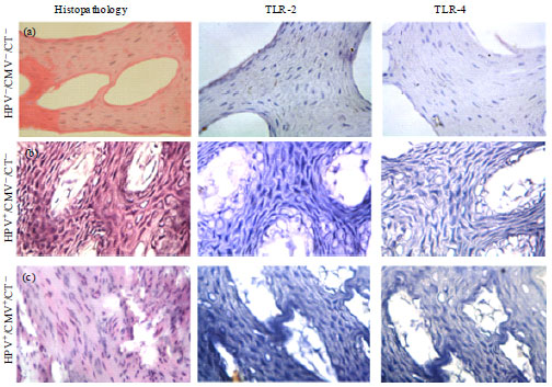 Image for - Prevalence of Human Papillomavirus, Cytomegalovirus and Chlamydia trachomatis among Women with Normal Cervical Cytology and their Impact on TLRs Expression