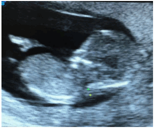 Image for - Subclinical Hypothyroidism Effect on Interpretation of Nuchal Translucency Early in Pregnancy